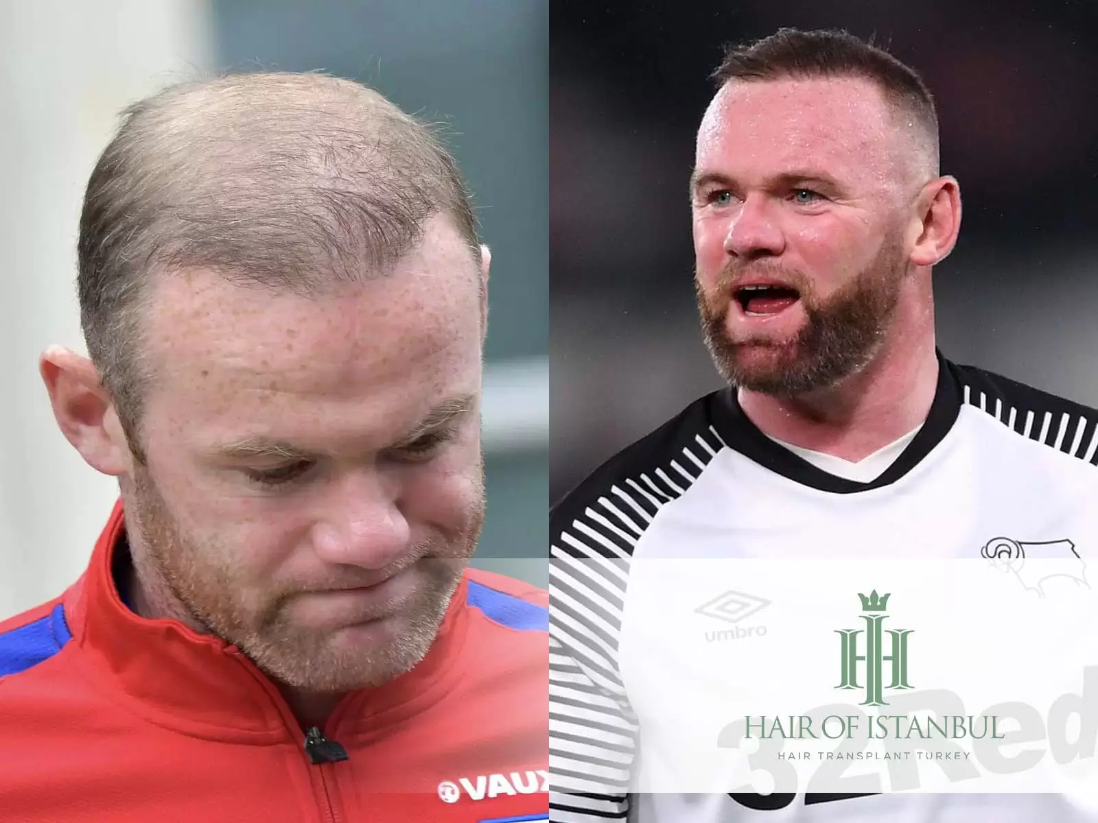 Wayne Rooney’s Hair Transplant The Story Behind His New Look! Hair