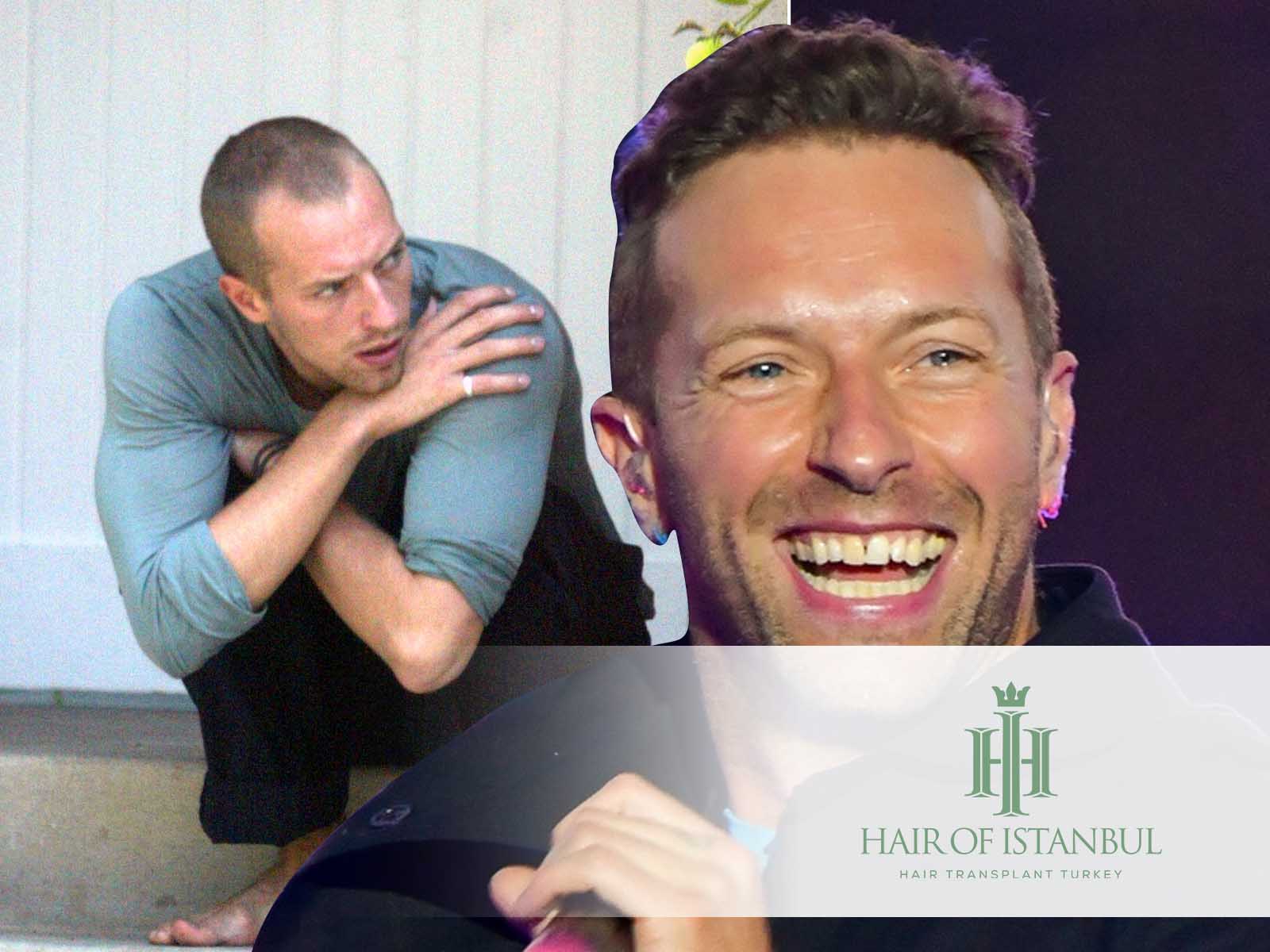 Chris Martin Hair Transplant: Spotlight on Scalp Secrets