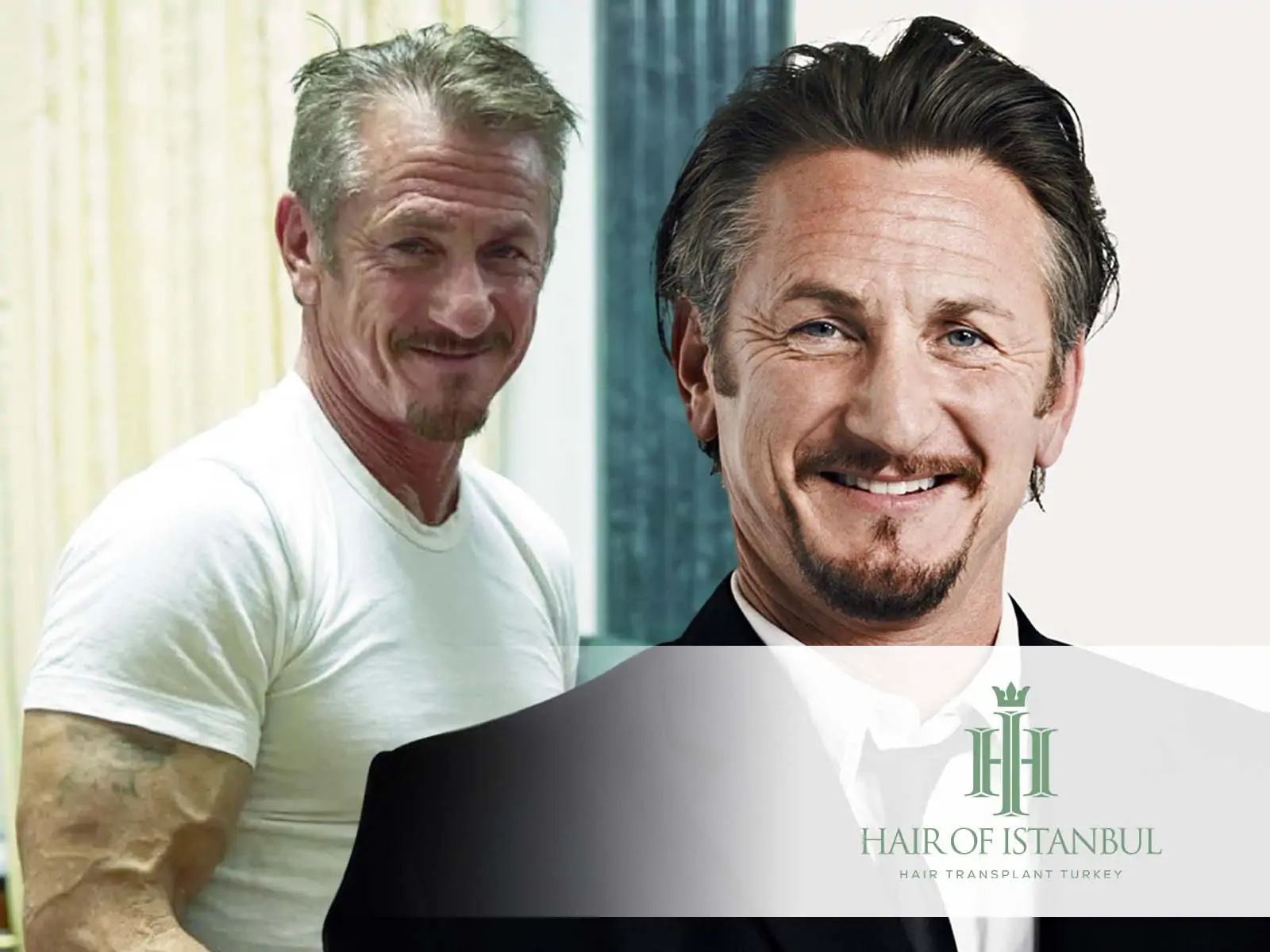 Sean Penn Hair Transplant A Closer Look at the Truth