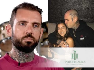 adam22-hairtransplant