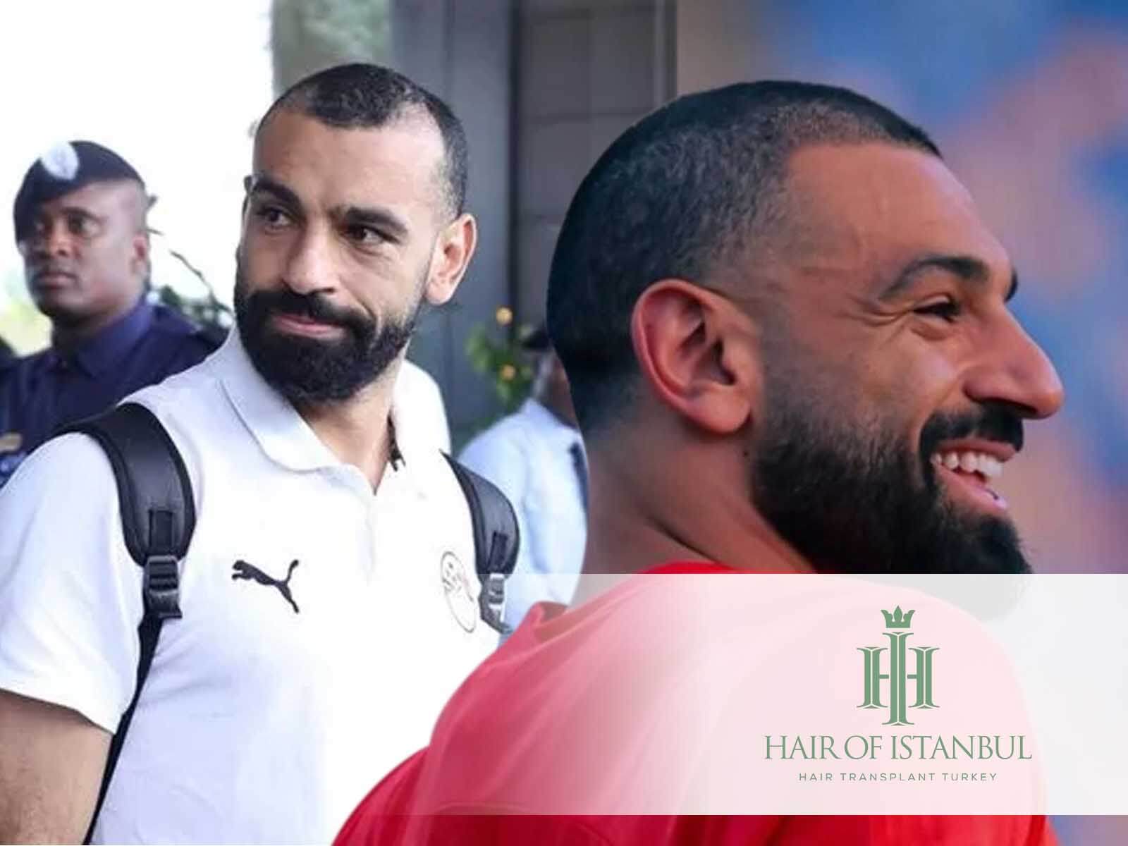 Mo Salah Hair Transplant: Examining the Shift in His Hairline