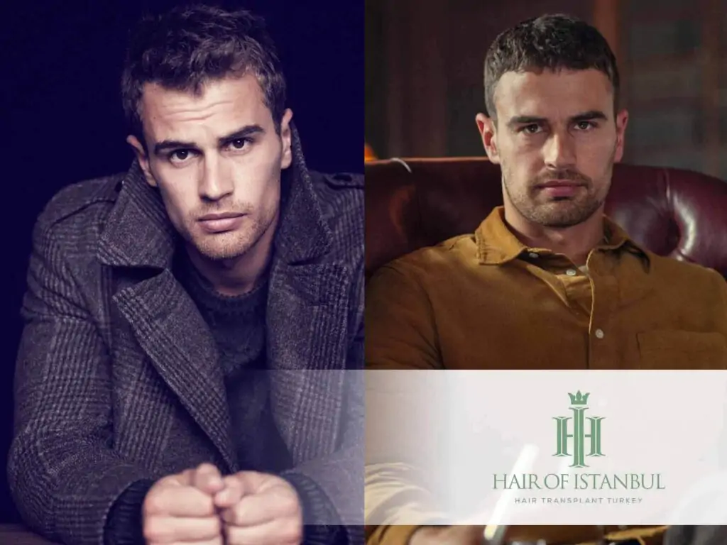 Theo James Hair Transplant